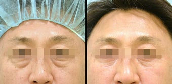 Lower Eyelid(Blepharoplasty) Surgery before 656865