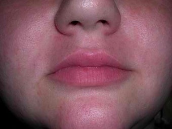 Female Treated with Cosmetic Filler after 1010868