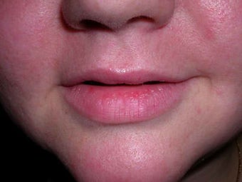 Female Treated with Cosmetic Filler before 1010868