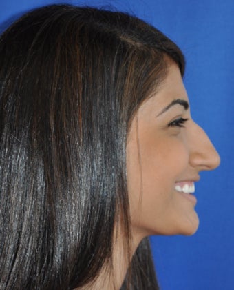 Teenage Rhinoplasty Before and Afters before 782420
