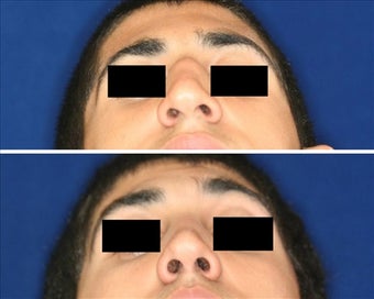 Before and after septoplatsy before 768216
