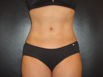 Hi-definition sculplting with Smartlipo and "PRO-Sculpt" Formula after 615670