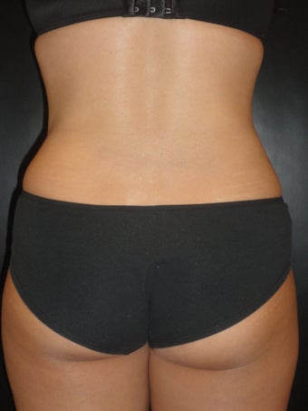 Hi-definition sculplting with Smartlipo and "PRO-Sculpt" Formula 615670