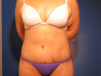 Body Contouring after Massive Weight Loss after 715487