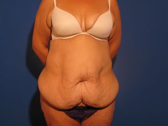Body Contouring after Massive Weight Loss before 715487