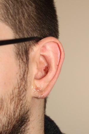 Repairing stretched earlobes and ears damaged by piercing 909040