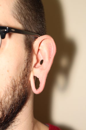 Repairing stretched earlobes and ears damaged by piercing 909040