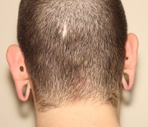 Repairing stretched earlobes and ears damaged by piercing before 909040