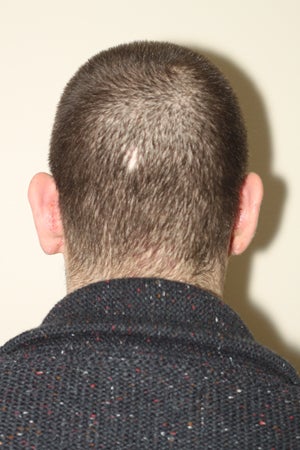 Repairing stretched earlobes and ears damaged by piercing after 909040