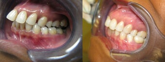 Invisalign (severe overbite) before 1236051