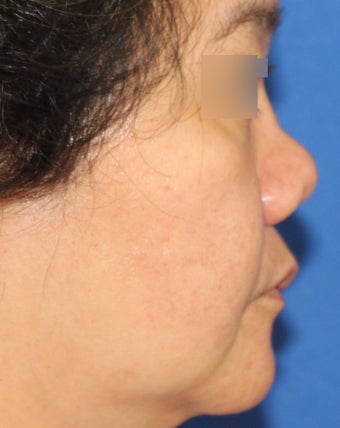 Revision Asian Rhinoplasty before 944171