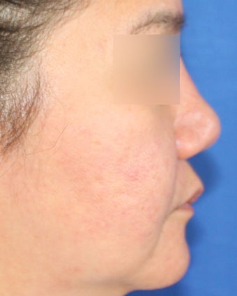 Revision Asian Rhinoplasty after 944171