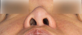 Revision Asian Rhinoplasty 944171