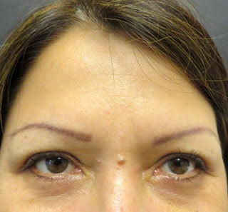 Treatment for Forehead Lines and Crows Feet after 1357220