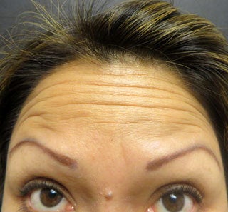 Treatment for Forehead Lines and Crows Feet before 1357220