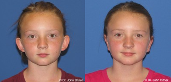 Otoplasty before 1156612