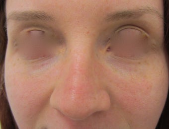 22 year-old female treated with Restylane filler for Tear Trough after 989346