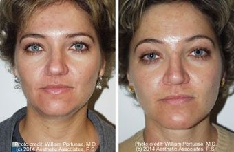 Neck Lift and Chin Implant before 91532