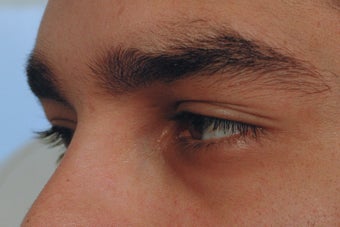 Dark Circles Under Eyes Before and After Restylane before 1105892