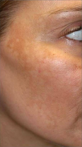 Fraxel - Melasma before 652325