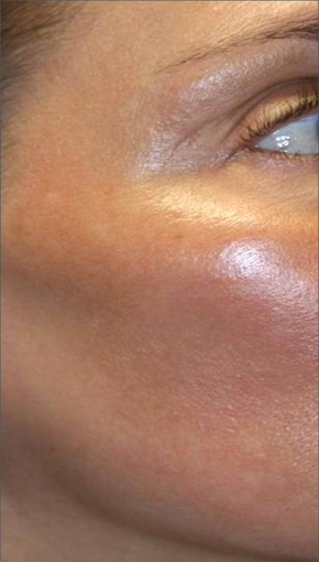 Fraxel - Melasma after 652325