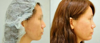 Chin Augmentation (Chin Implant) before 921732