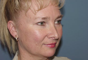 Patient requesting correction for sub-optimal results after esthetic nasal surgery 892528