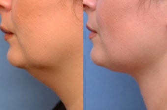 Chin liposuction before 635987