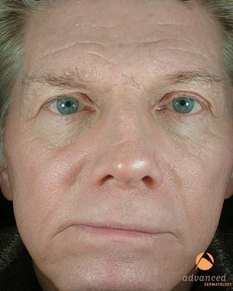 Male Patient Treated with BOTOX® Cosmetic, Perlane® & Sculptra® before 1047014