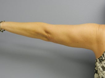 Before Laser Lipo / Arms 382290