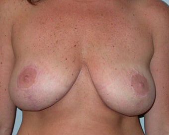 Breast Lift Procedure for 38 Year Old Woman after 876610