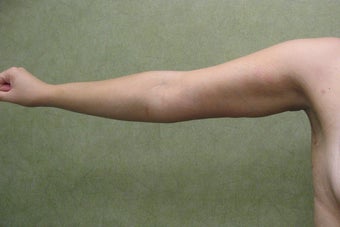 Arm Lift after 479037