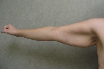 Arm Lift before 479037