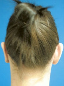 Otoplasty Ear Surgery - Woman 818053