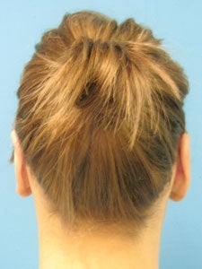 Otoplasty Ear Surgery - Woman 818053
