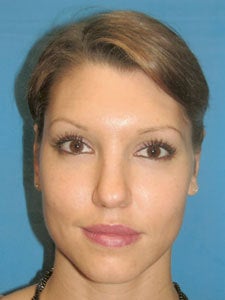 Otoplasty Ear Surgery - Woman after 818053