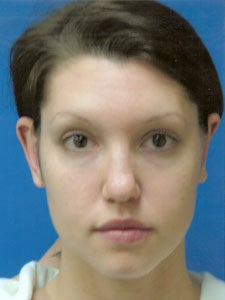 Otoplasty Ear Surgery - Woman before 818053