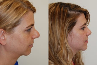 Revision Rhinoplasty Surgery. 8 months post-op. before 930154
