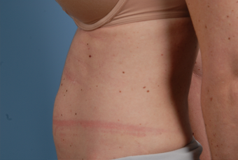 TruSculpt 894730