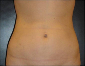 SmartLipo MPX after 686023