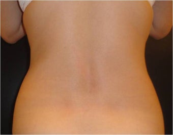 SmartLipo MPX 686023