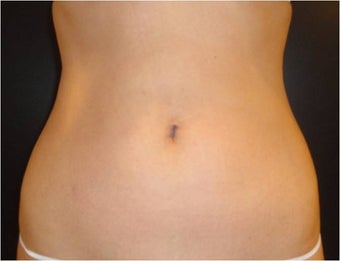 SmartLipo MPX before 686023