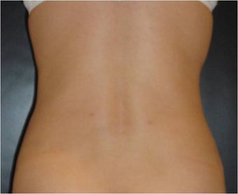 SmartLipo MPX 686023