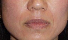 Soft Tissue Fillers Patient before 969765
