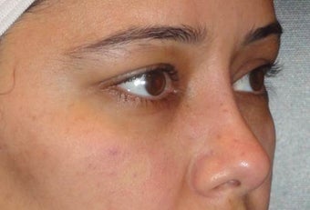Restylane after 959471