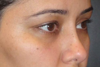 Restylane before 959471