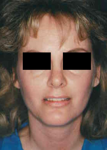Revision Rhinoplasty after 665077
