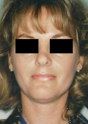 Revision Rhinoplasty before 665077