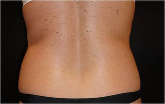 SmartLipo MPX 686076