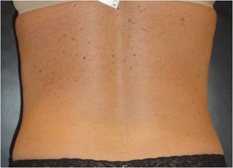SmartLipo MPX 686076